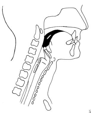 Oral propulsive phase of normal swallowing.