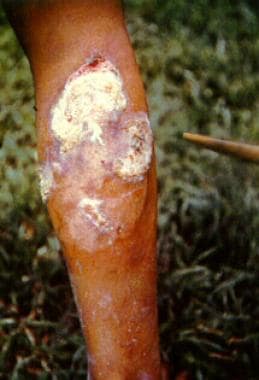 Violaceous psoriatic plaque of early pinta. Perine