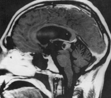 T1-weighted contrast-enhancing sagittal MRI from a