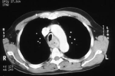 Esophageal cancer. Chest CT scan showing invasion 