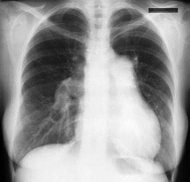 Chest radiograph of patient with nonidiopathic pul