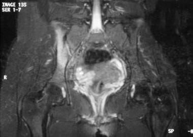 MRI of the same patient whose radiography findings