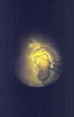 This is an endoscopic image of a holmium laser fib