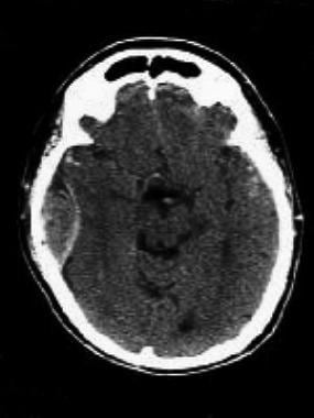 Right temporal epidural hematoma with midline shif