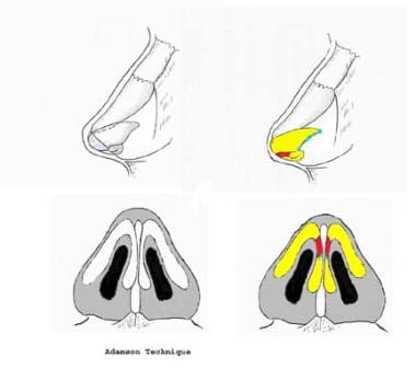 Vertical Dome Division Rhinoplasty Treatment Management Surgical Therapy Preoperative Details Complications