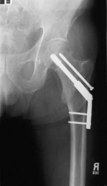 Internal fixation of the subcapital femoral neck f