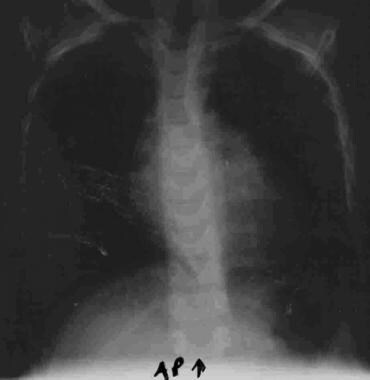 Chest radiograph of 5-year-old girl with mitral va
