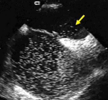 Bubble-contrast injection during Valsalva maneuver