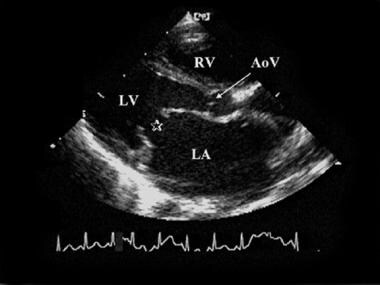 normal mitral valve echo