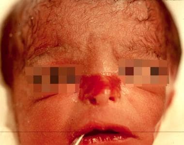 Congenital localized absence of skin, nose, in a n