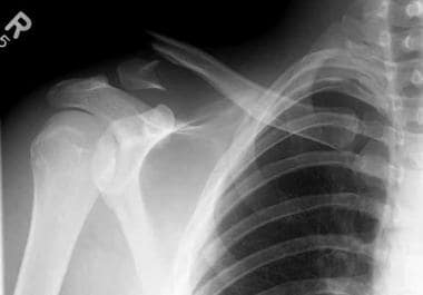Anteroposterior view of distal clavicle fracture, 