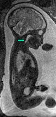 Fetal MRI revealing esophageal atresia. Proximal e