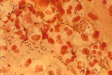 streptococcus pneumoniae gram stain csf