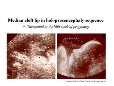 Median cleft lip on ultrasound. 