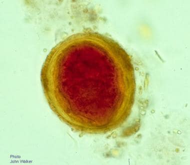 Egg of Schistosoma mekongi (53 X 45 μm) in the fec