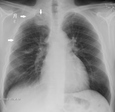Chest radiograph (CXR) of a 50-year-old male who p