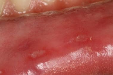 Minor aphthous ulcer: Small superficial oval erosi