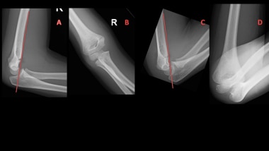 normal humerus x ray growth plates