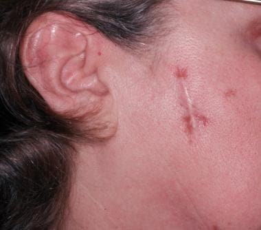 结石病有疤痕的渗透。