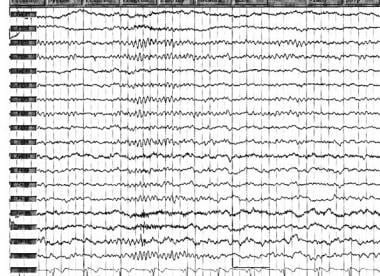 Preoperative EEG in a patient with a right tempora