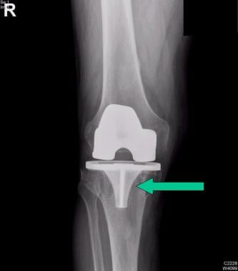 全膝关节假体周围骨溶解。