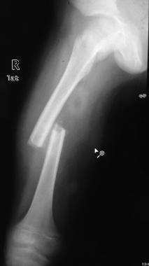 x rays of broken femur