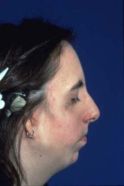 Preoperative appearance of patient with Treacher C