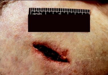 A chop wound produced by a tomahawklike tool. Note