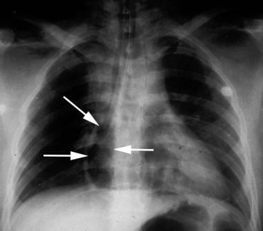 Postmortem chest radiograph showing a radiolucent 