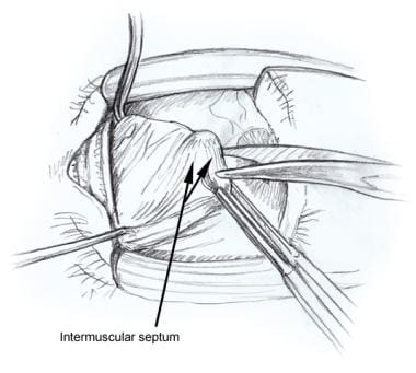 Recession of Medial Rectus Muscle: Overview, Indications, Contraindications