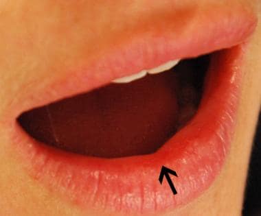 line that connects lip to gum