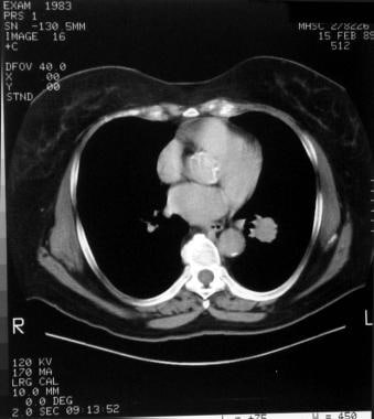 Computed tomography (CT) scan of a patient with a 