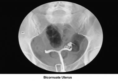 Infertility. Bicornuate uterus. Image courtesy of 