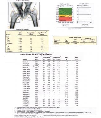 Sample results from a workup for osteoporosis usin