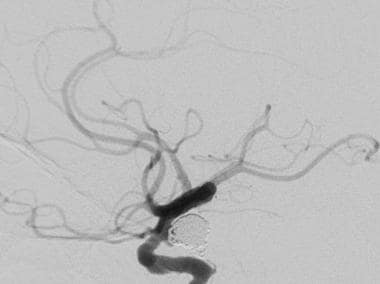Follow-up cerebral angiogram in the same patient a