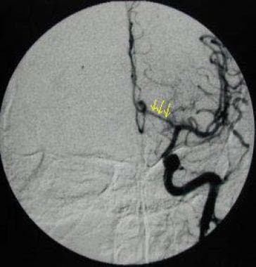 Angiogram obtained in the anteroposterior projecti