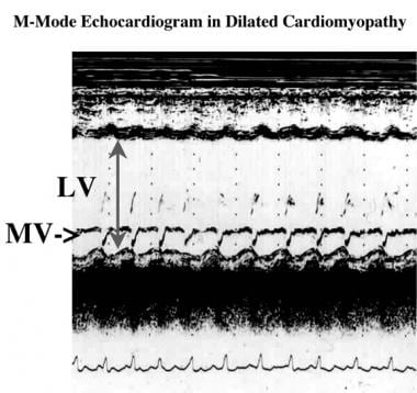M-mode echocardiogram acquired at the level of the