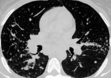 Sarcoidosis, thoracic. Pulmonary window CT image i