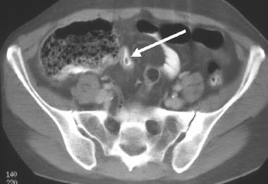Crohn disease in a young woman; computed tomograph