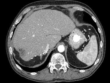 CT scan in a patient following a partial hepatecto
