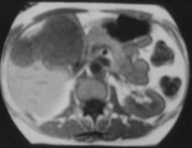 T1-weighted magnetic resonance image of the liver 