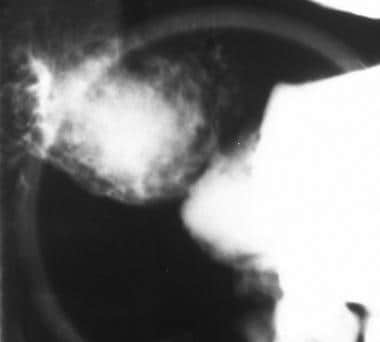 Sprue. Spot radiograph from a single-contrast uppe
