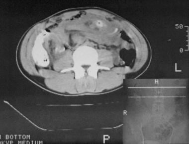 CT scan abdomen showing compression at D3 with dilated stomach and