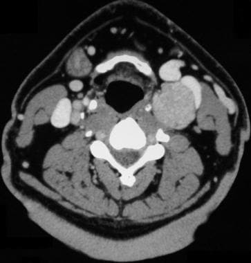 Carotid body tumor. Computed tomography scan shows