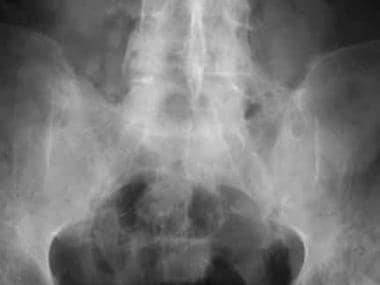 Bilateral chronic sacroiliitis. Frontal radiograph