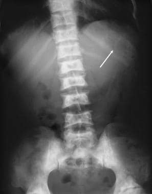 Plain abdominal radiograph in a patient with sickl