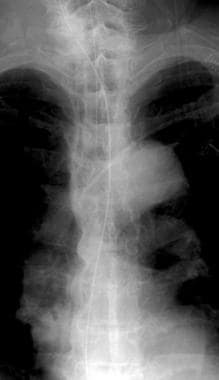 Radiograph of the thoracic spine (anteroposterior 