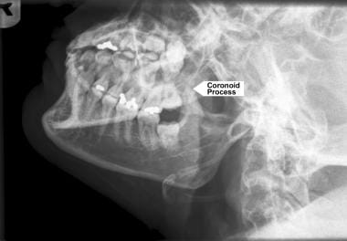 The coronoid is best seen on an oblique radiograph