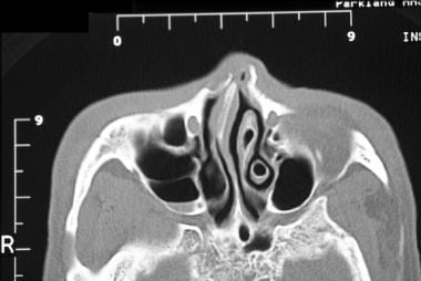 Nasal fractures. Axial CT scan demonstrates a nasa