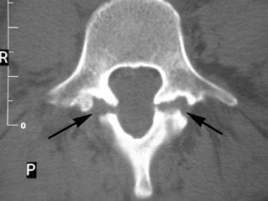 Spondylolisthesis. Axial CT image shows bilateral 
